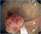 Polypabtragung/Mucosaresektion in Ihrer Gastroenterologieprxis in Worms